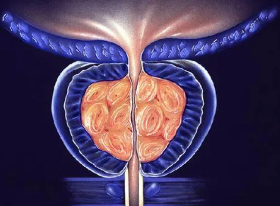 急性前列腺炎標準治療患者應避免的4個生活習慣